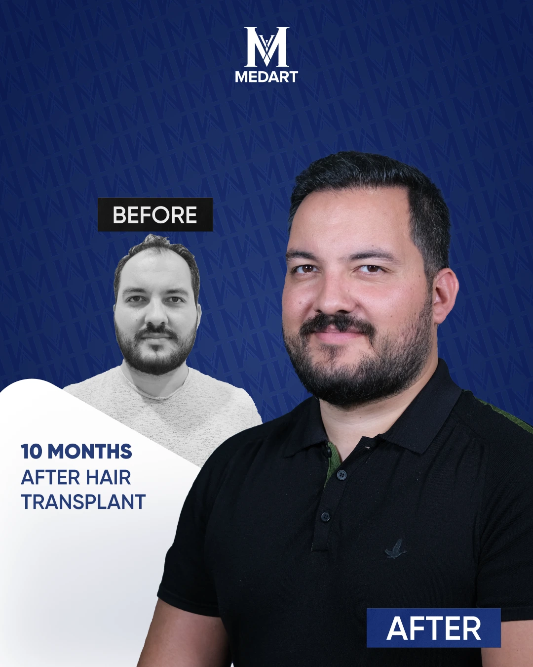 Résultats de Greffe de Cheveux DHI