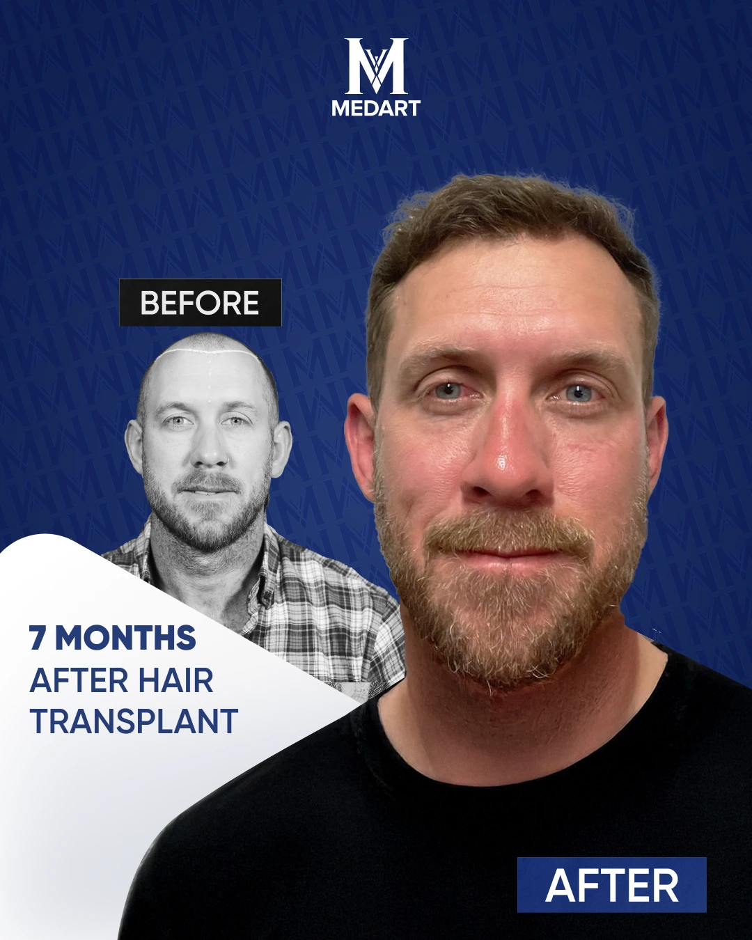 Résultats de Greffe de Cheveux DHI