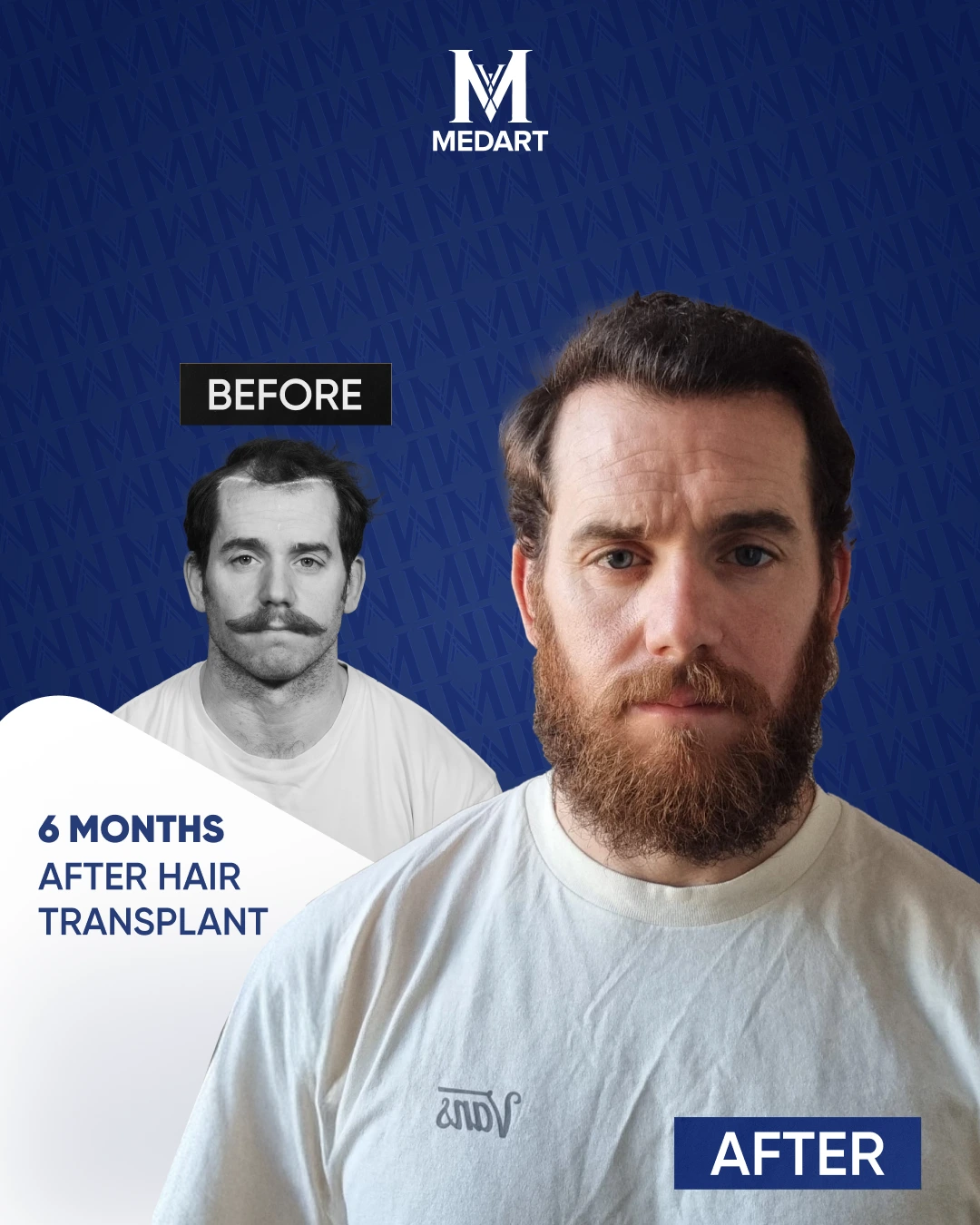 Résultats de Greffe de Cheveux DHI