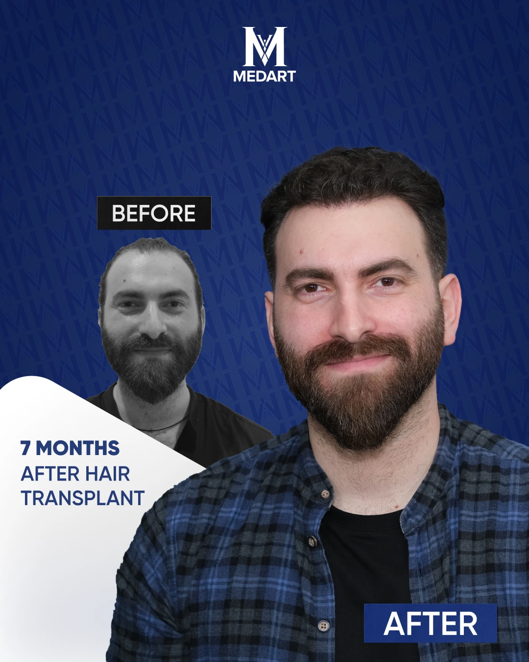 Résultats de Greffe de Cheveux Saphir