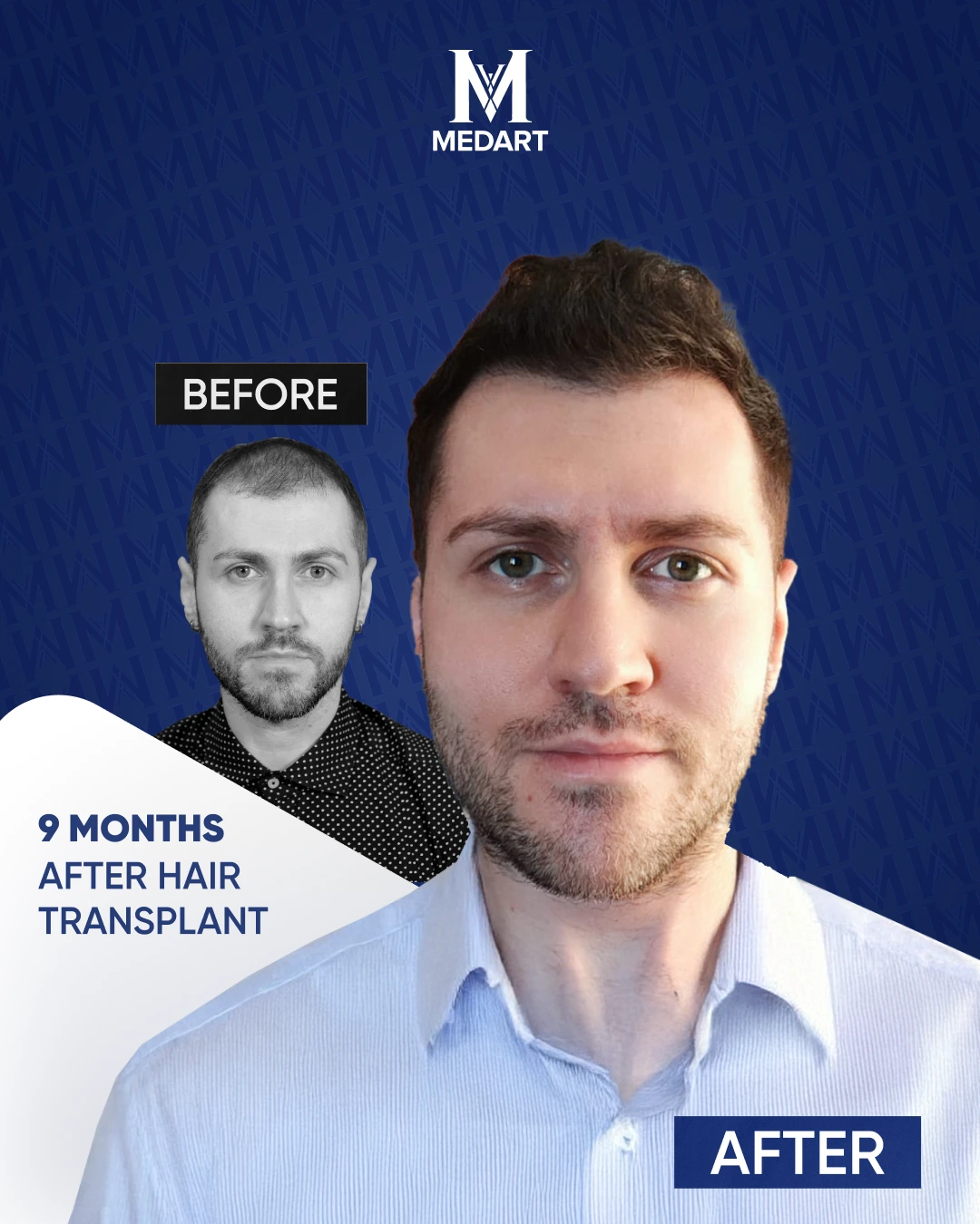 Résultats de Greffe de Cheveux Saphir