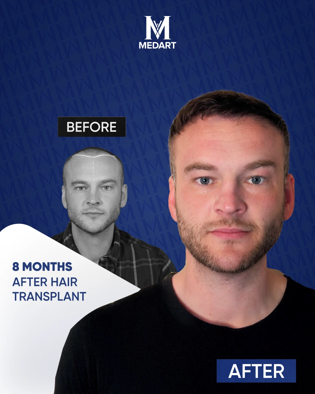 Résultats de Greffe de Cheveux Saphir