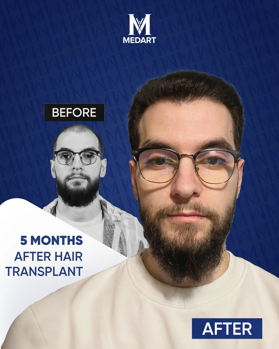 Résultats de Greffe de Cheveux Saphir